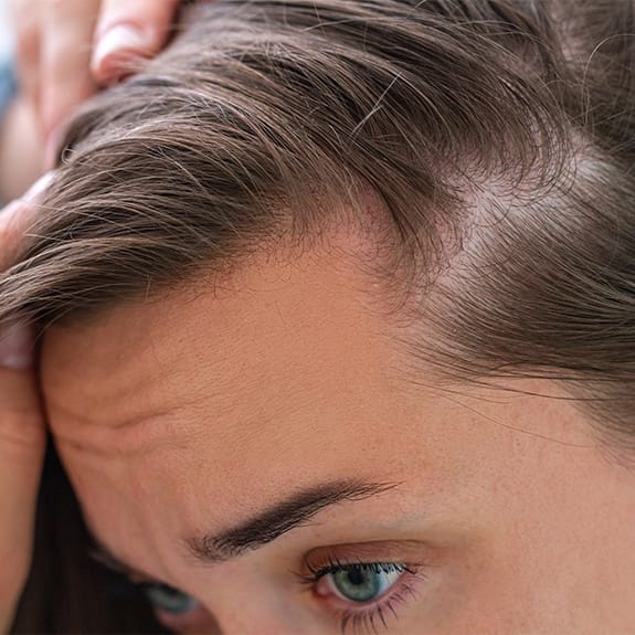 Woman's scalp after P R P hair restoration