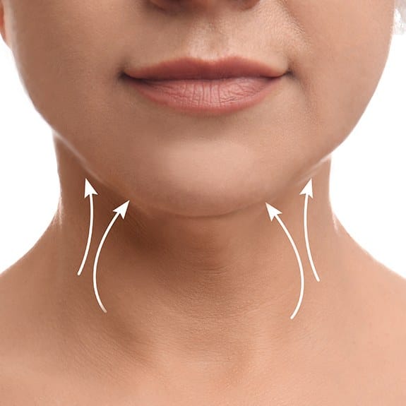 Woman's neck showing results of Kybella