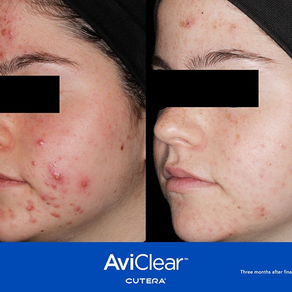 Woman enjoying clear skin after successful acne treatment with AviClear