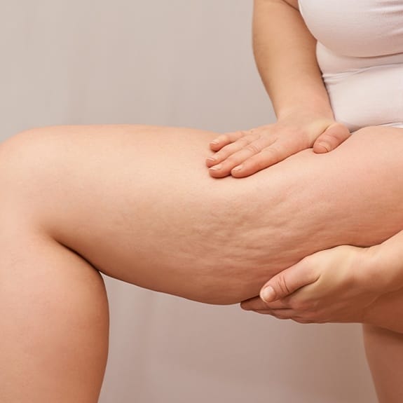 View of thigh before skin tightening treatment