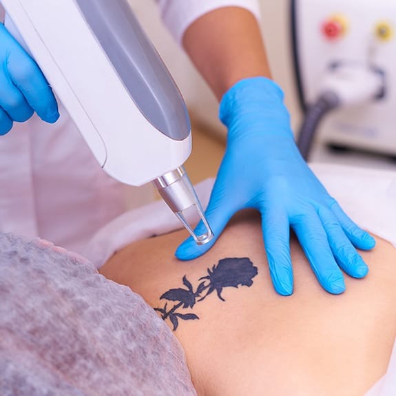 Patient receiving laser tattoo removal