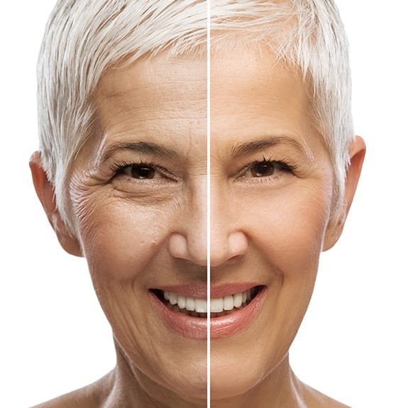 Woman before and after Botox treatment