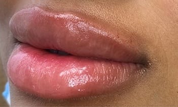 Clouse of mouth after injectable treatment