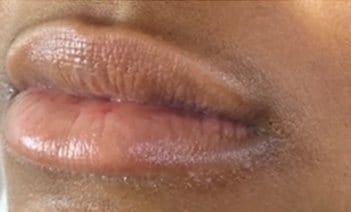 Closeup of mouth before injectable treatment