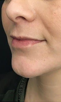 Lips before injectable treatment