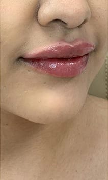Closeup of lips after injectable treatment