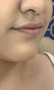 Closeup of lips before injectable treatment