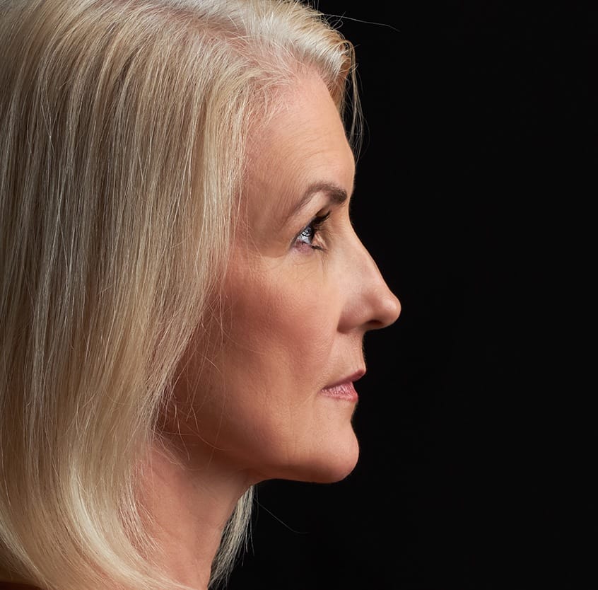 Older woman looking more youthful after dermal filler treatment