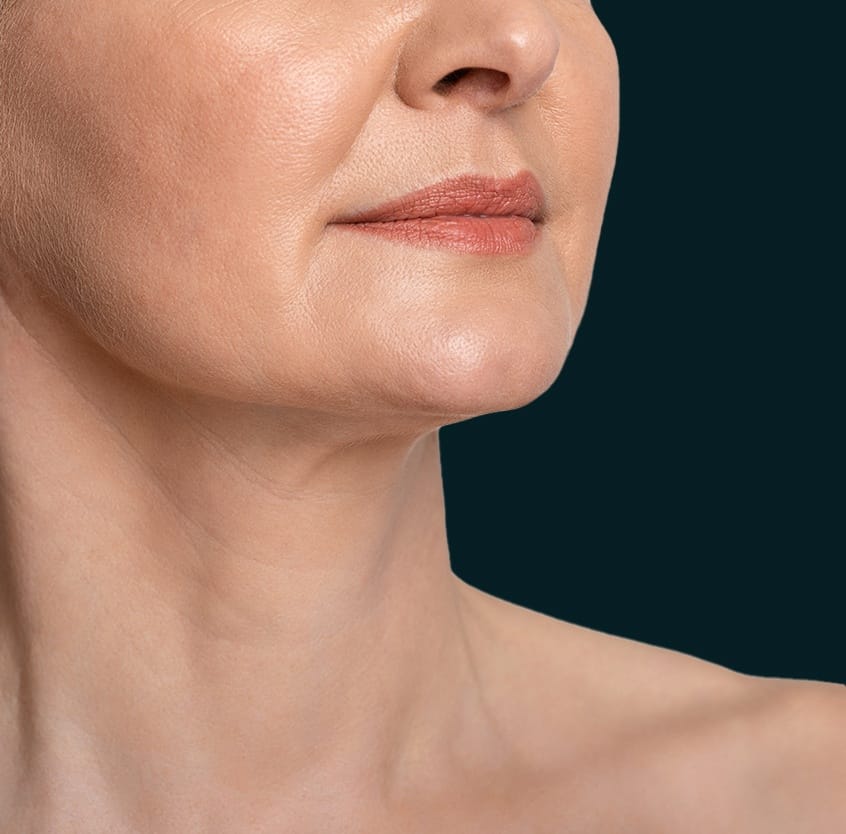 Closeup of jaw line and neck after Kybella
