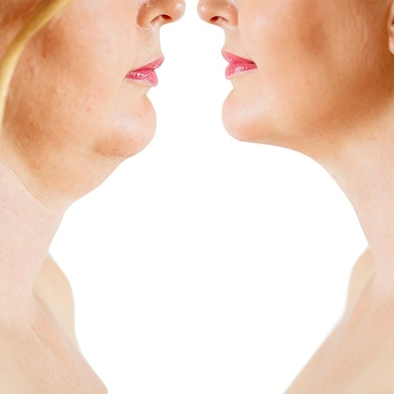 Woman's chin and neck before and after Kybella