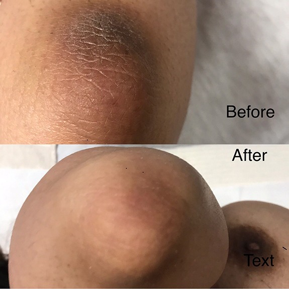Patient’s elbow before and after treatment with Pink Intimate