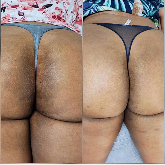 Woman’s buttocks before and after Pink Intimate treatment