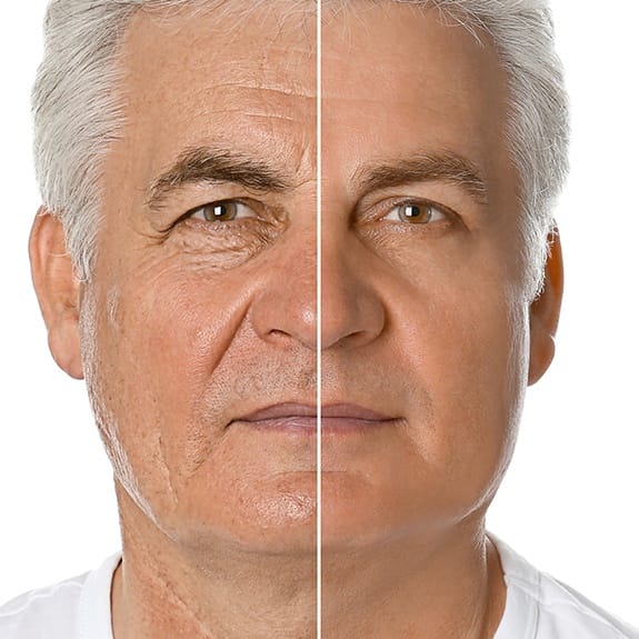 Man before and after radio frequency microneedling treatment