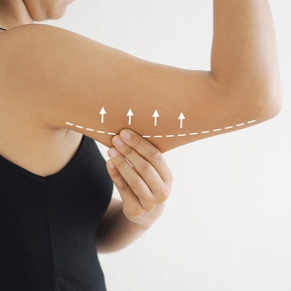 Woman pinching area of arm to receive thread lift