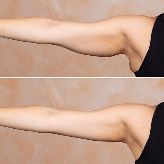 Patient's under arm skin before and after TruScultp I D treatment