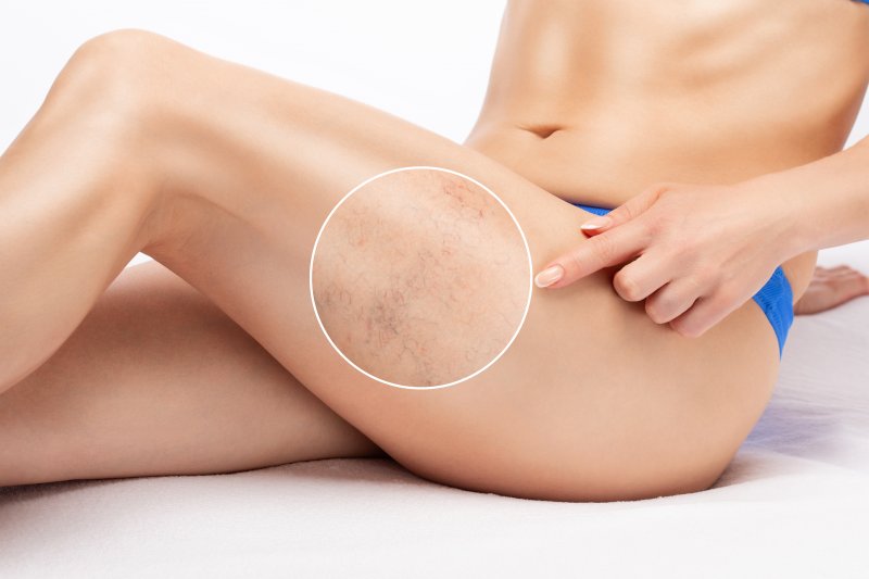a person with spider veins