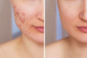 Woman’s face before and after AviClear acne treatment