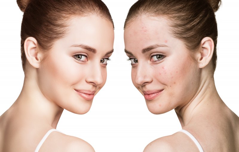woman before and after acne treatment